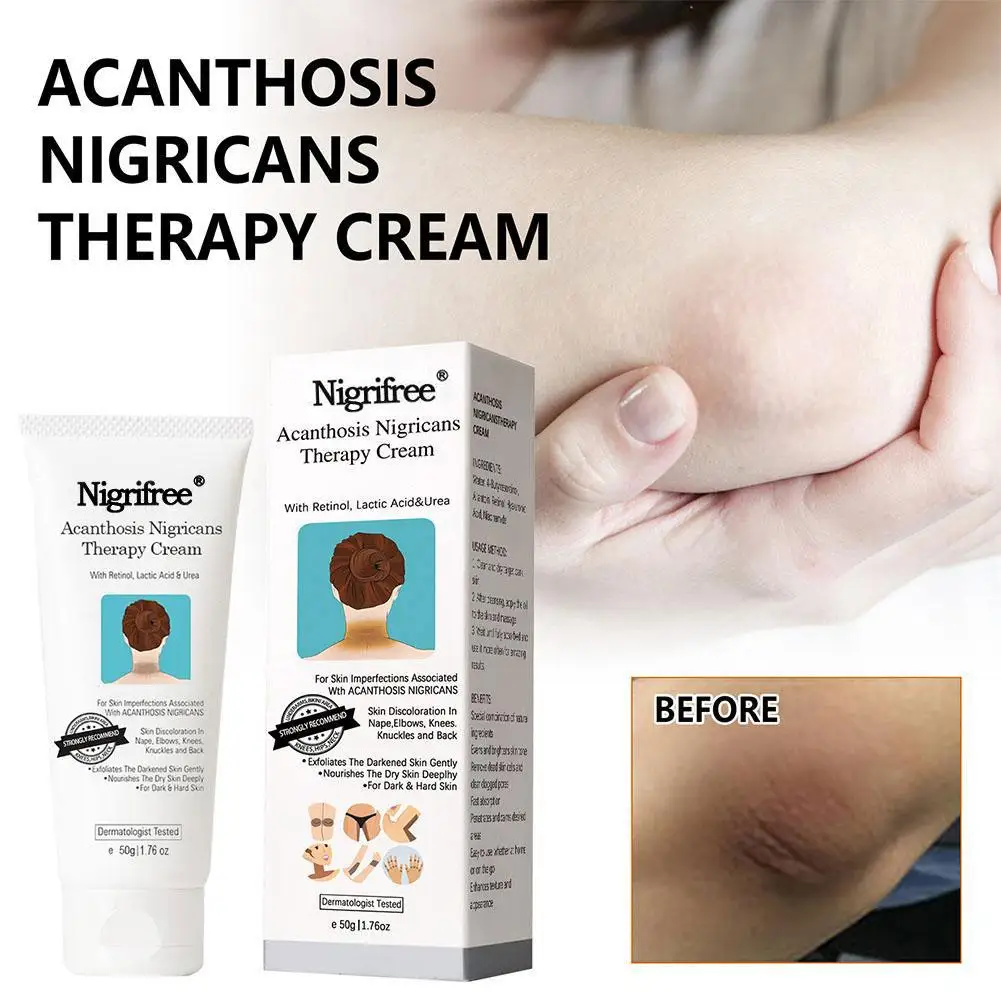 Acantosis Nigricans crema de terapia blanqueadora corporal eliminación de hiperpigmentación para el cuidado de las partes del cuerpo oscuras como el cuello, An X2e9