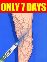 Bolígrafo de luz azul Ahorre venas varicosas Piernas de araña en 7 días