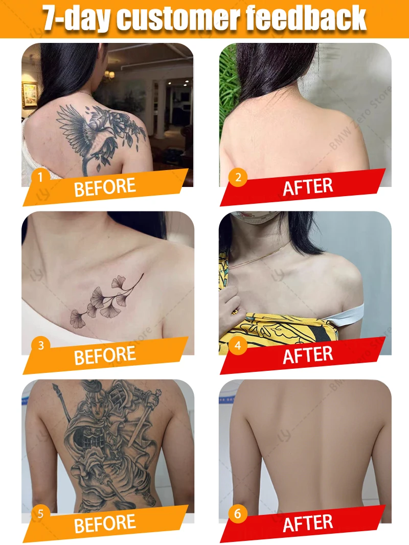 Rimozione del tatuaggio pigmentata per trucco permanente Rimozione rapida del tatuaggio
