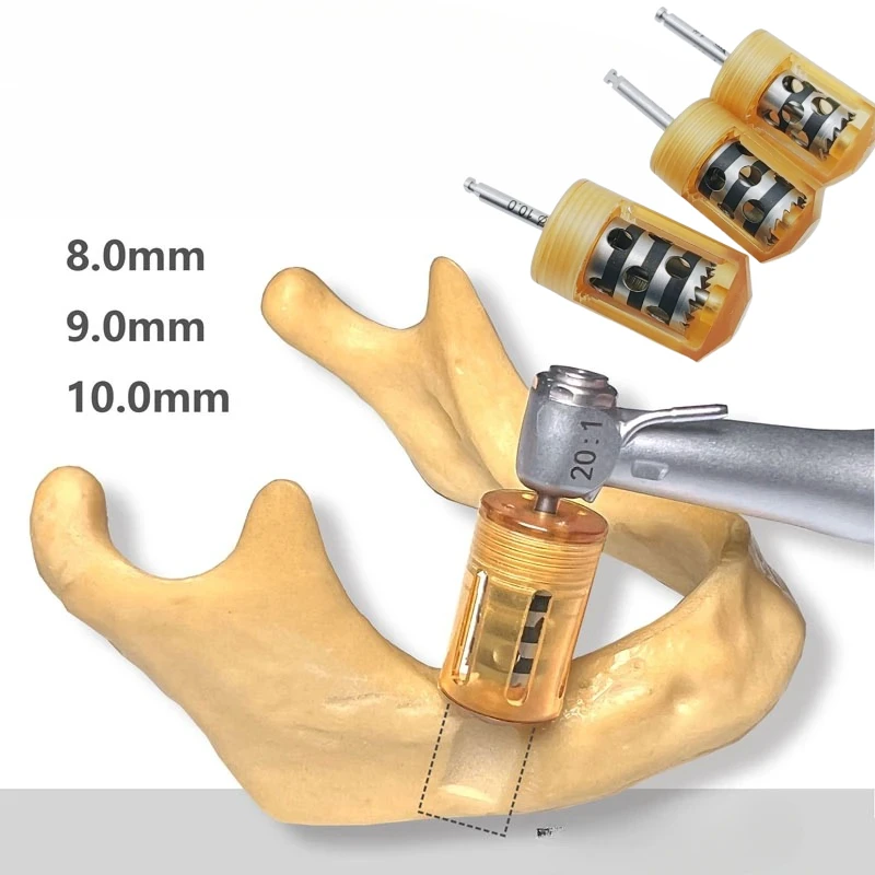 Dental Bone Collector Semilunar Technique GBR SLT Drill Implant Semilunar Shell Bone Surgery To Extract Flake Bone
