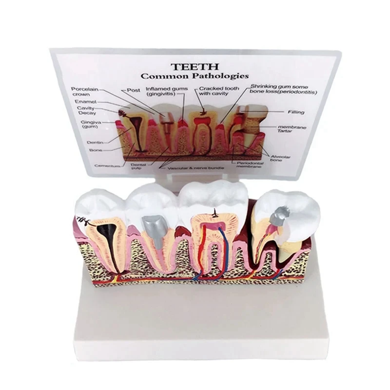 ABNO-Standard  Oral Teeth Anatomical Teaching Model Comprehensive Tooth Structure Model Dentist  Demonstration