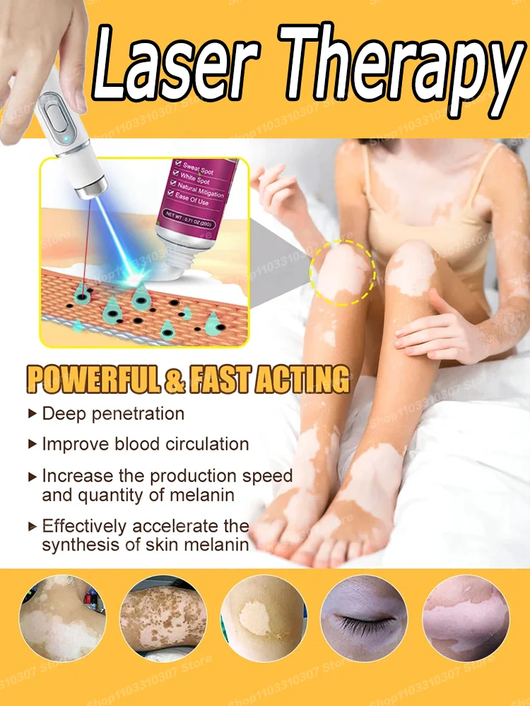 

Vitiligo laser treatment pen for men and women