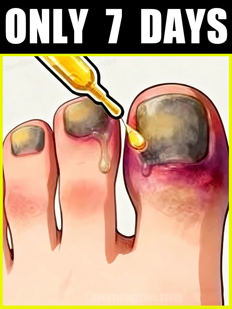 

When nails show discoloration, peeling,or breakageᴰⁱˢⁱⁿᶠᵉᶜᵗ ᵃⁿᵈ ᵖʳᵒᵗᵉᶜᵗ ᵃˢ ᵉᵃʳˡʸ ᵃˢ ᵖᵒˢˢⁱᵇˡᵉ