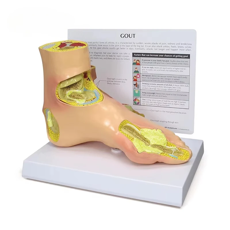 Pathological model of gout complications, medical model of foot and ankle joint