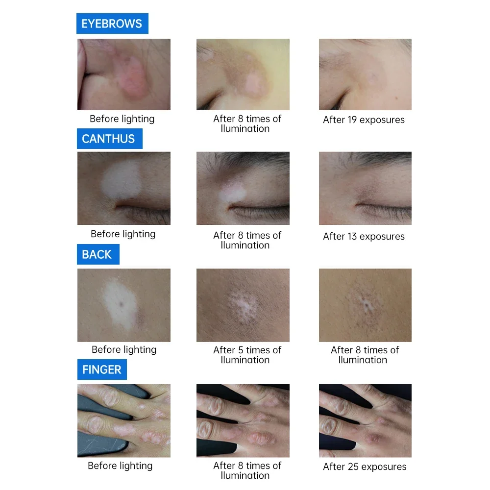 고품질 휴대용 UVB 램프 311nm UV 광선치료 필수 물리치료 장비 효과적인 치료용