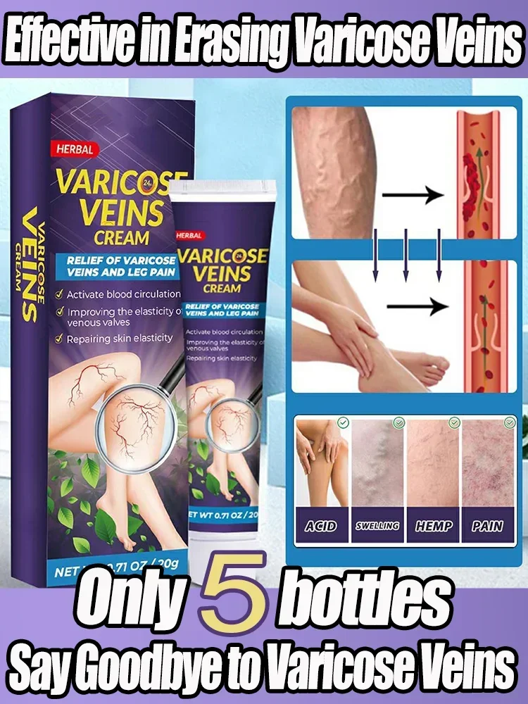 Varicose Veins Relief Cream Leg Vasculitis Phlebitis Spider Shape Vein Pain Relief Ointment Angiitis Removal Body Care Massage