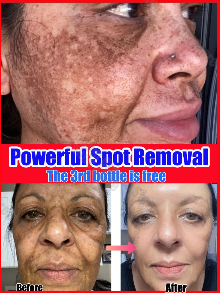 

Eliminate facial blemishes