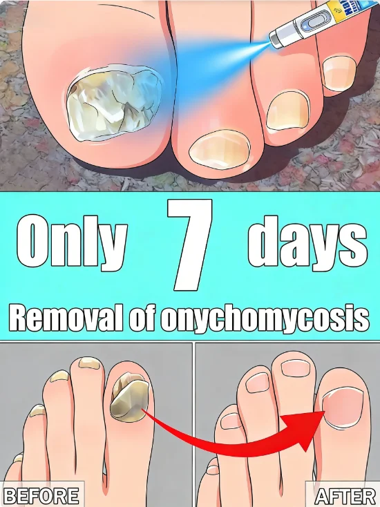 

2025 unisex blue light pen portable set: Say goodbye to nail problems within 5 days