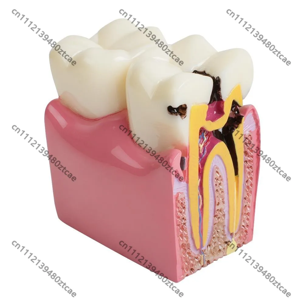 1:6 Magnified Dental Caries Model Oral Tooth Anatomy Comparison Model Dentistry Teaching Study Demonstration Tool