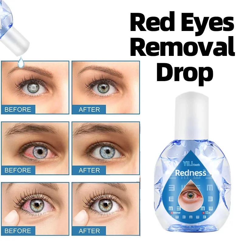 

Red Eyes Treatment Eye Drop Relief Eye Discomfort Visual Fatigue Dry Eyes Pain Excessive Eye Use Protect Vision Care Drops 12Ml