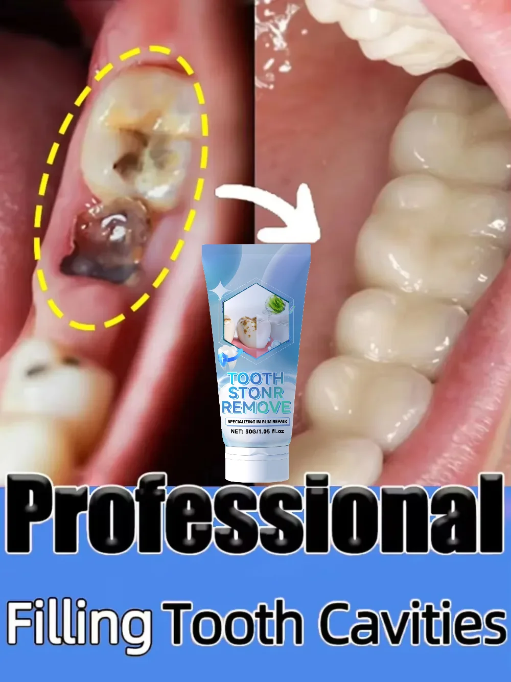 إصلاح الأسنان، ويمنع تساقط الأسنان، وإزالة لوحة الأسنان بشكل فعال #1