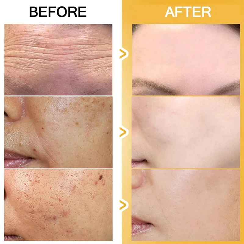 Suero blanqueador de pecas con vitamina C, crema para eliminar manchas oscuras, Melasma, niacinamida, aclara la melanina, cicatrices del acné, antienvejecimiento, cuidado de la piel