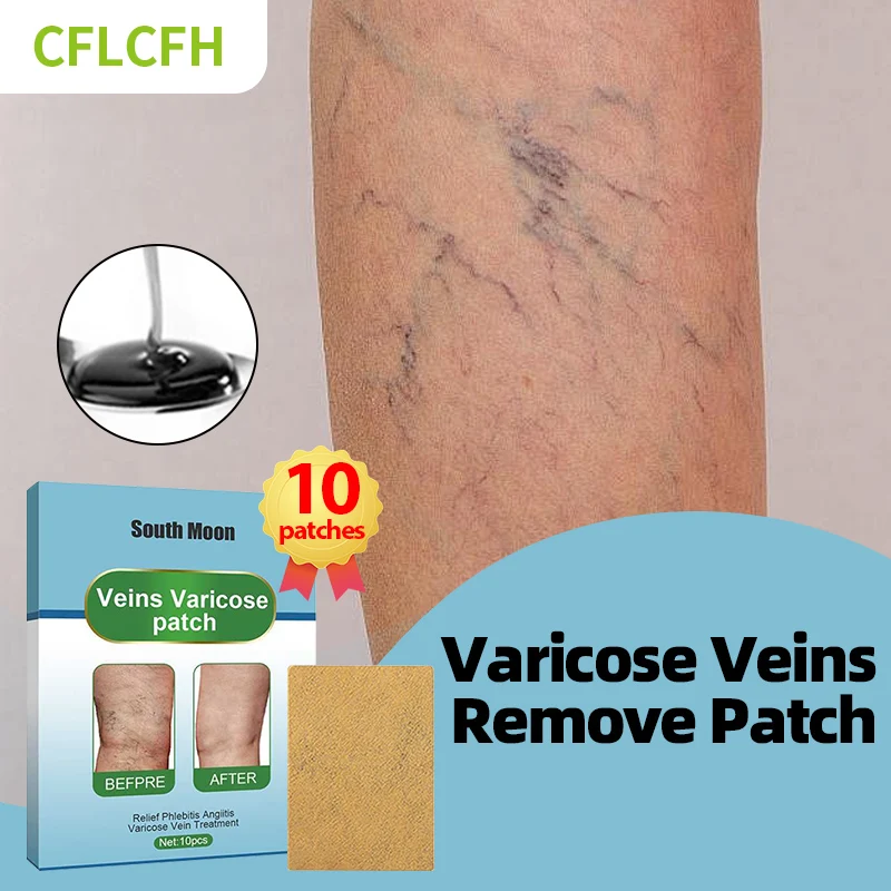 

Varicose Veins Relief Medical Patch Spider Leg Vasculitis Phlebitis Varicosity Angiitis Legs Dilated Treatment Foot Care Plaster