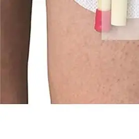 

Повязка на ногу мочи, клейкая лента для фиксации мочи, держатель катетера, наклейка на трубку, ремень для сумки, стабилизация G, нефростомия