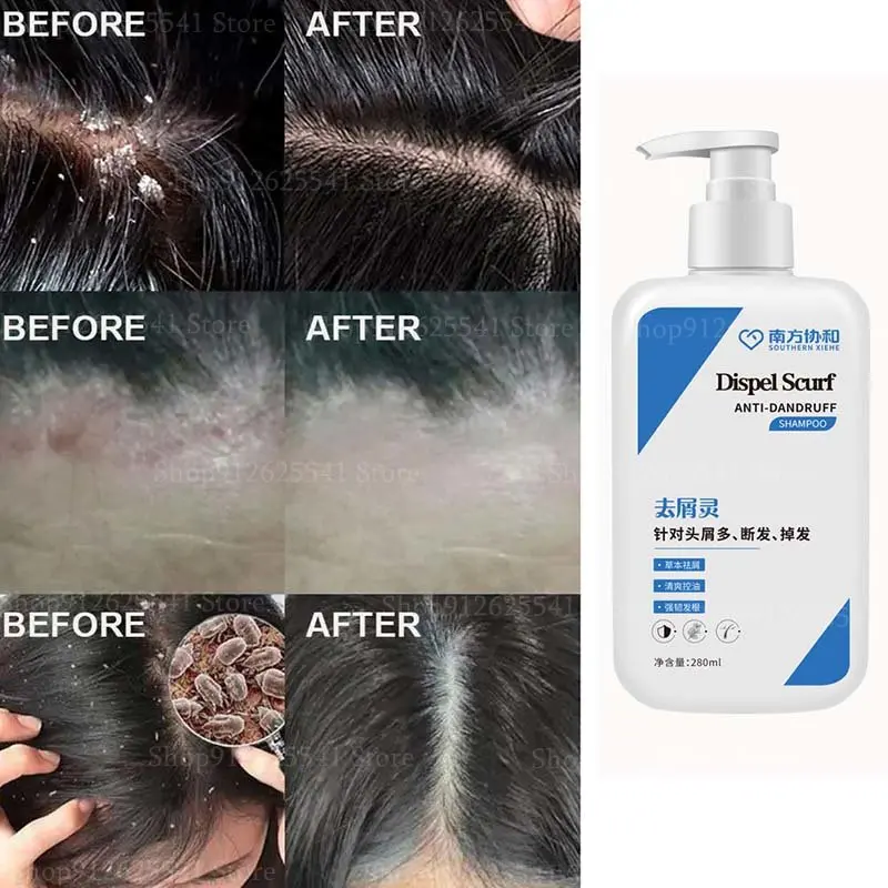 

280ml Anti Dandruff Head Itching Acne Head Mite Hair Loss Hair Shampoo Anti-dandruff Shampoo for Oil Control Refreshing