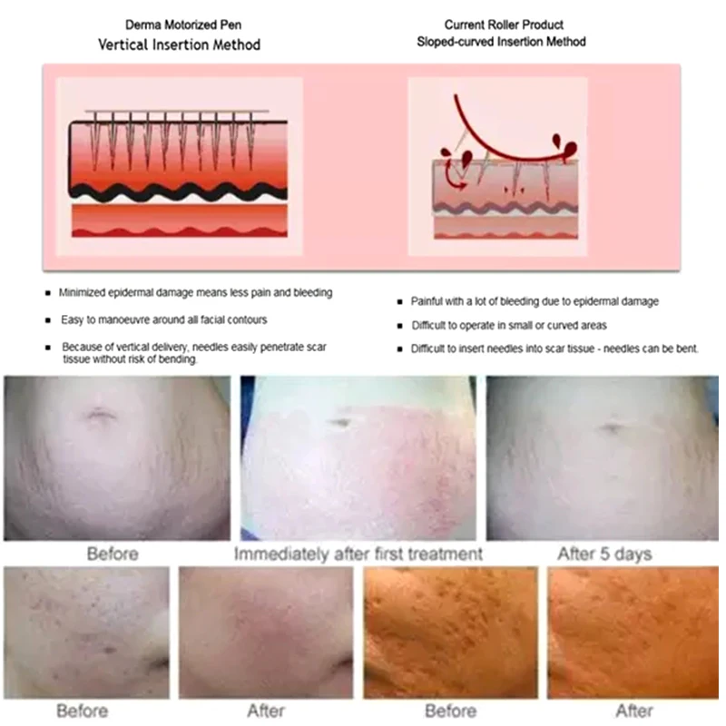 Рисунок 6 - Тату-картридж, иглы Nano Bayonet Microneedle