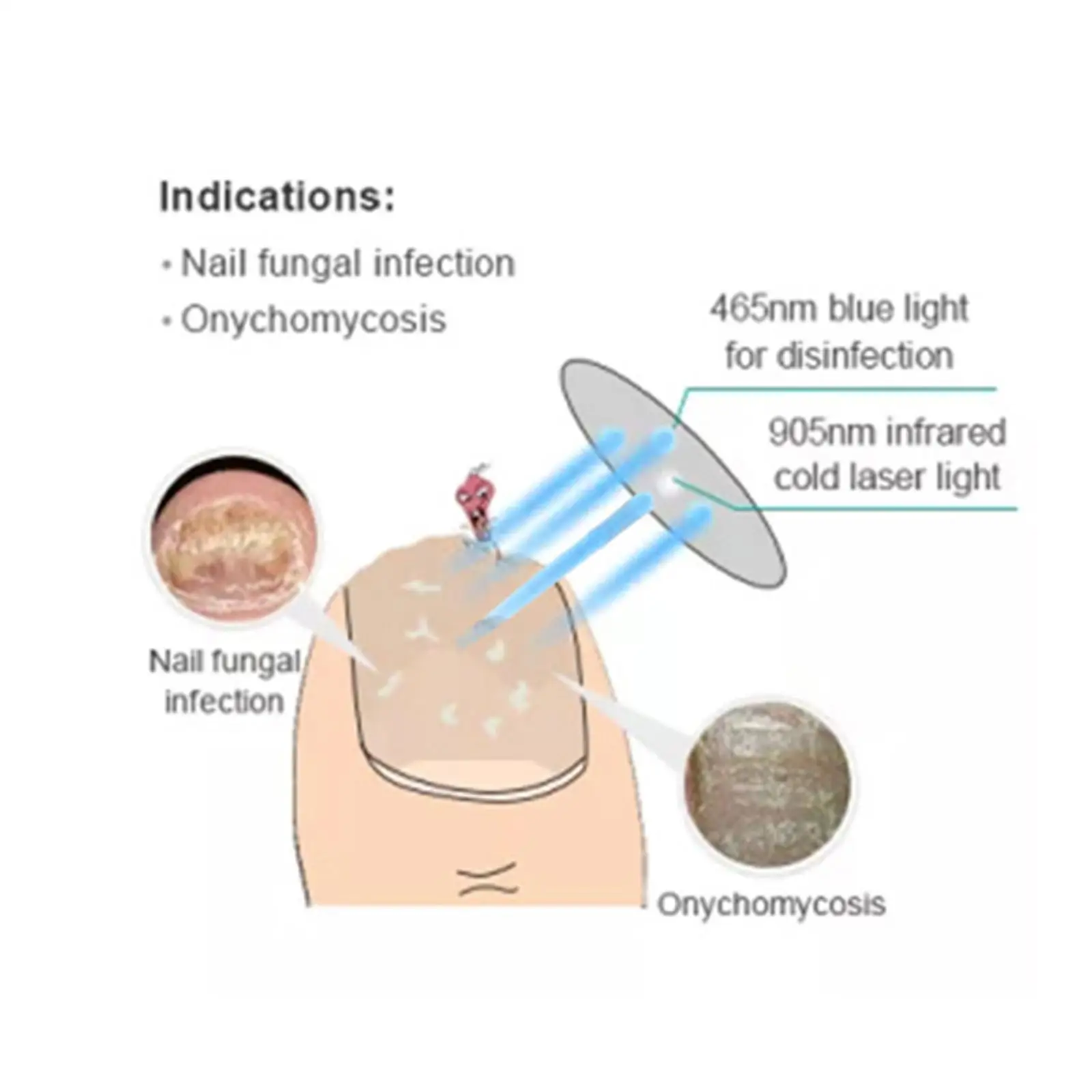 네일 곰팡이 레이저 치료 기계, 905nm 콜드 레이저 라이트, 465nm 블루 라이트