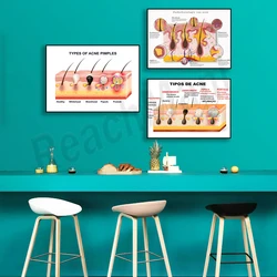 Acne formation, acne poster, skin anatomy, skin graphics, pathophysiology, dermatology, medical aesthetics poster decoration