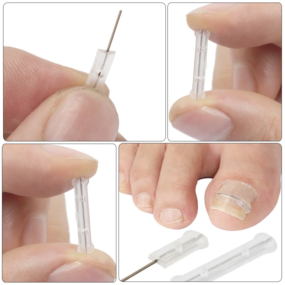 

10 Pieces Titanium Alloy Silicone Nail Corrector Wire Ingrown Toenail Treatment Compact Daily Use Tool Small Correction Wire