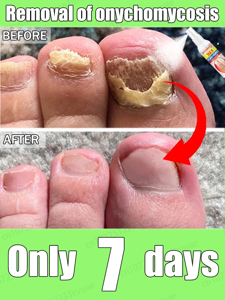 

Say goodbye to onychomycosis. Never get it back again. Get your nails back to normal.