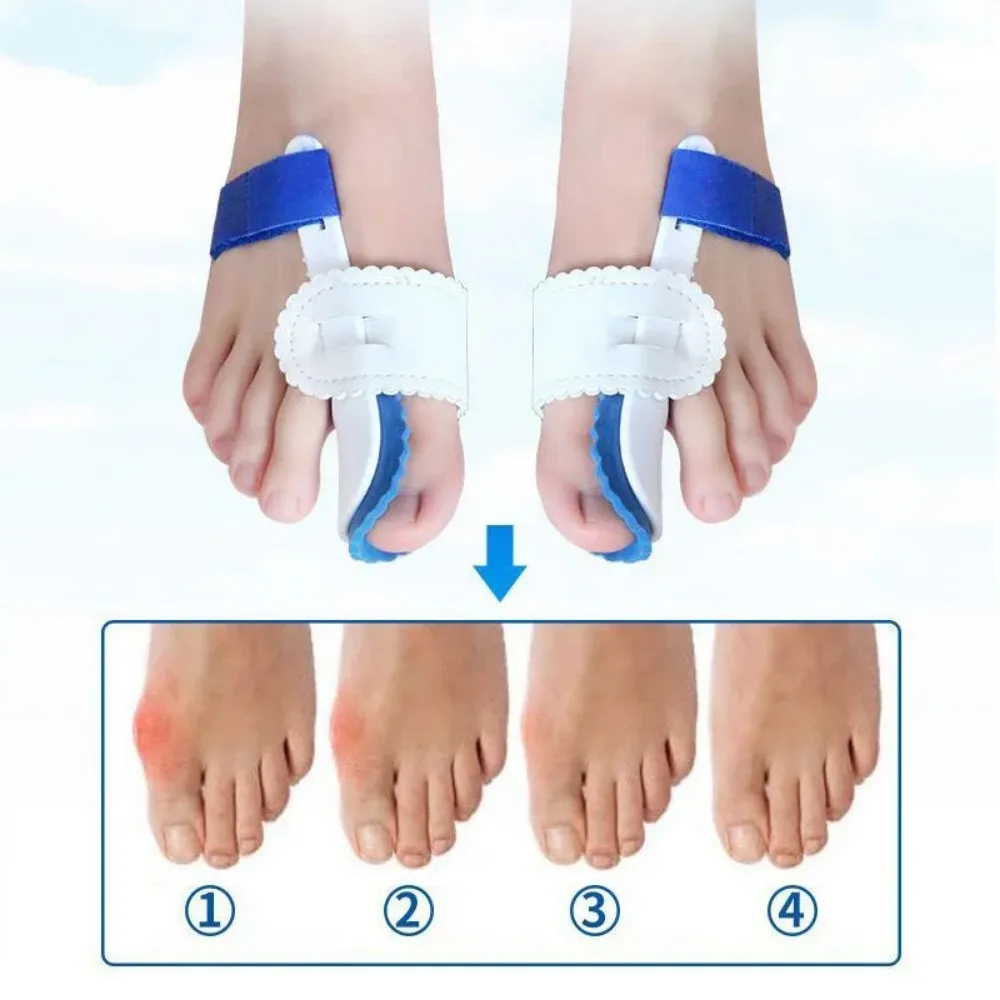 Corrector de Halux Valgus para dedos de los pies, separador de juanetes, separador de juanetes, 2 piezas