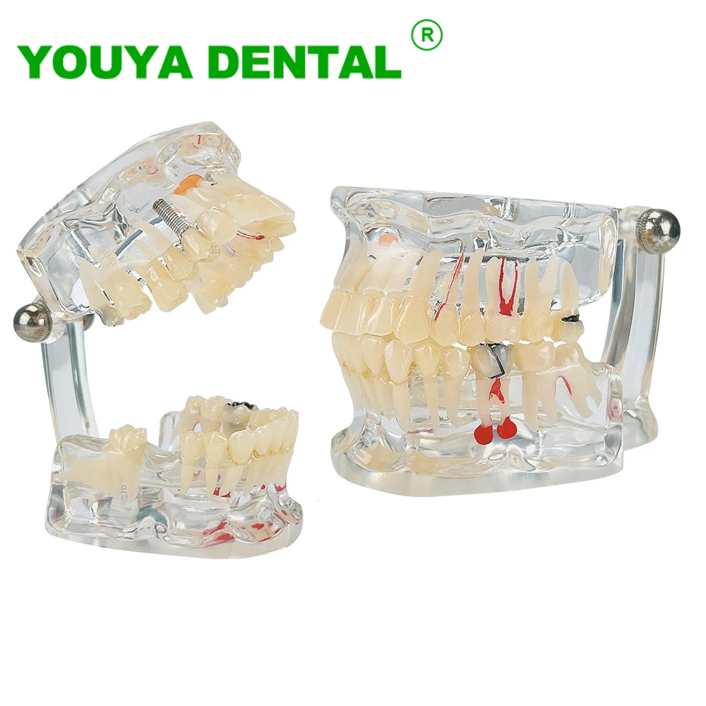 

Disease Teeth Model Dental Teaching Model Transparent For Dentistry Dentist Student Practice Training Patient Education Tools