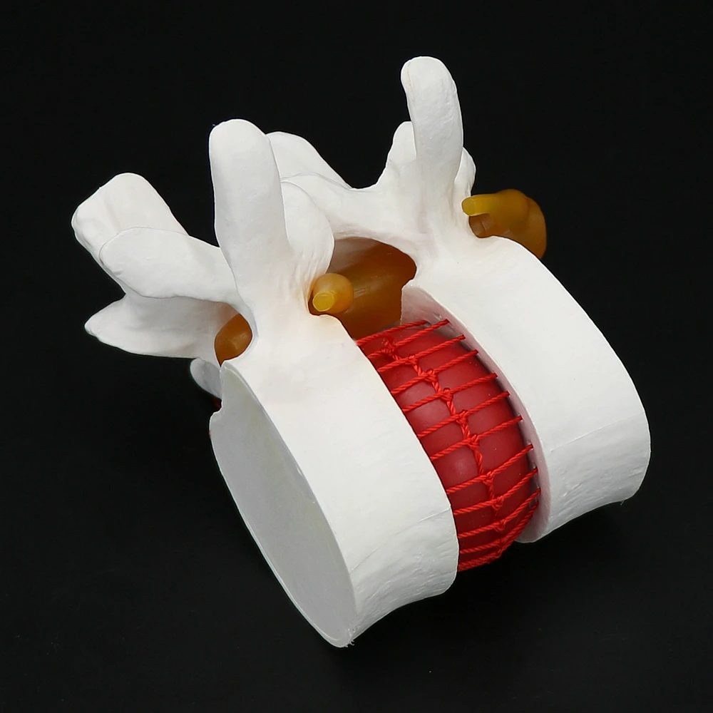 1Piece PVC Lumbar Vertebral Spine Model Teaching Aid Tool Demonstration Model Human Lumbar Disc Herniation Model