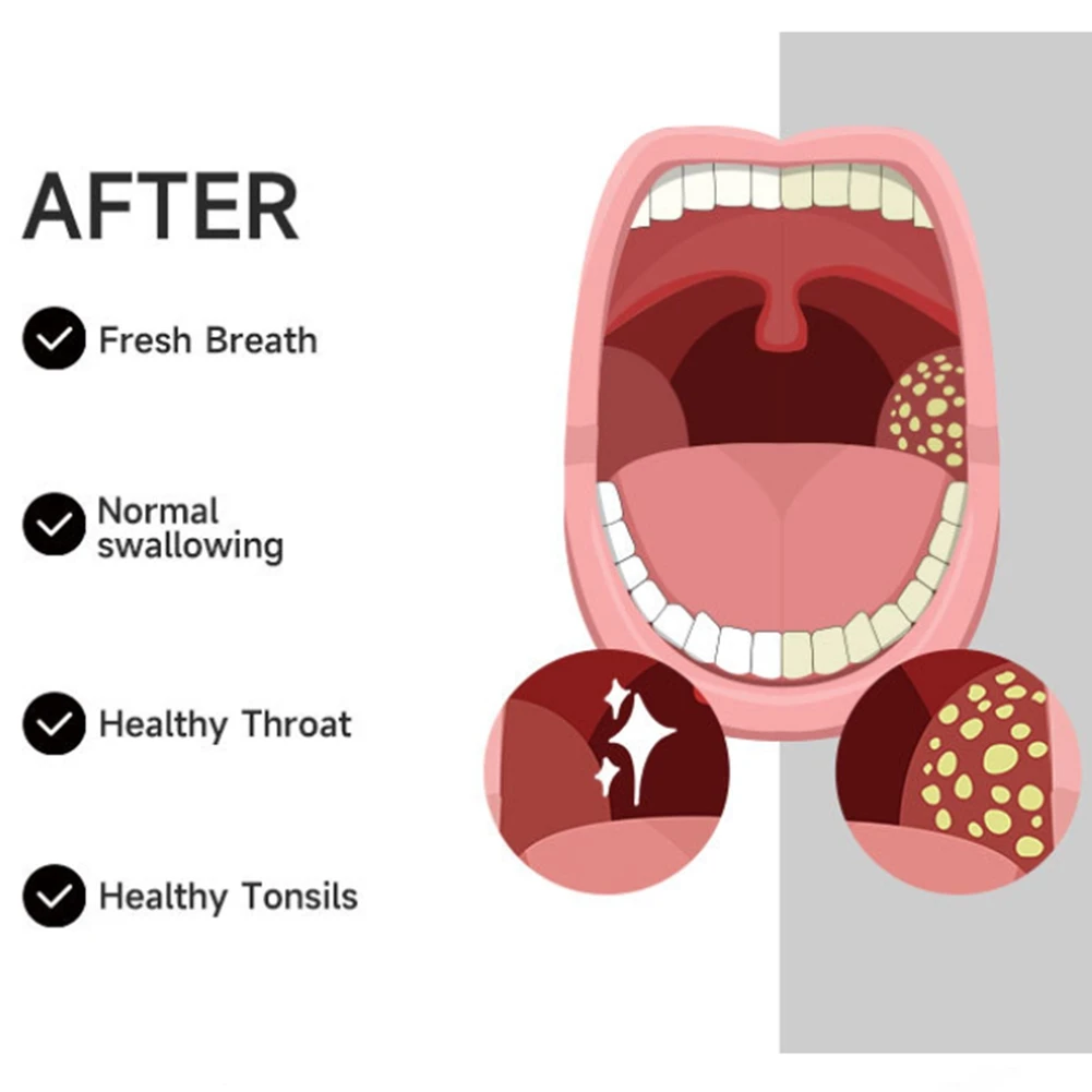 مزيل فراغ حجر BFYLTonsil، مجموعة إزالة حجر اللوزيل، أداة تنظيف الأسنان بالمياه، أداة العناية بتنظيف الفم الكهربائية أ