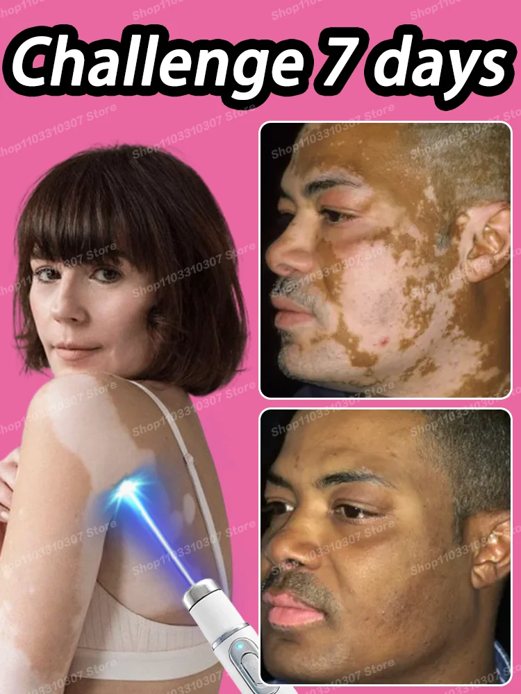 

Reduce White Spots Improve Skin Pigmentation Vitiligo Cream