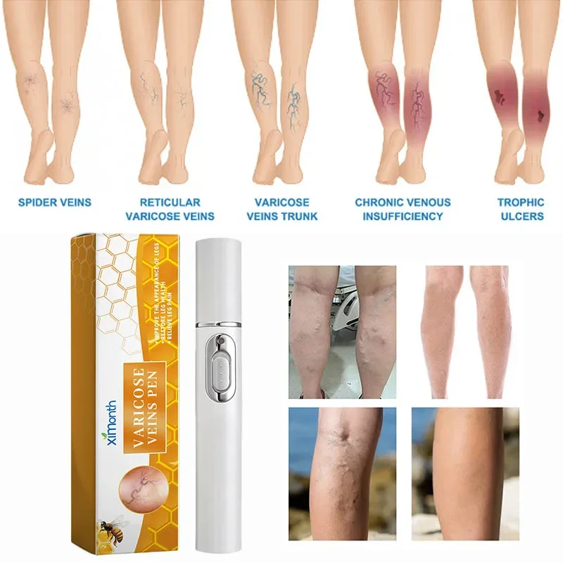 3Pcs Varicose Veins Laser Therapy Pen Relieve Legs Pain Varicose Vein Socks Leg Care For Men And Women Improve Blood Circulation