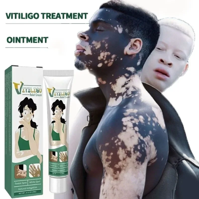 

Organic Vitiligo Treatment Cream With Herbal Extract for White Spot Ringworm Removal