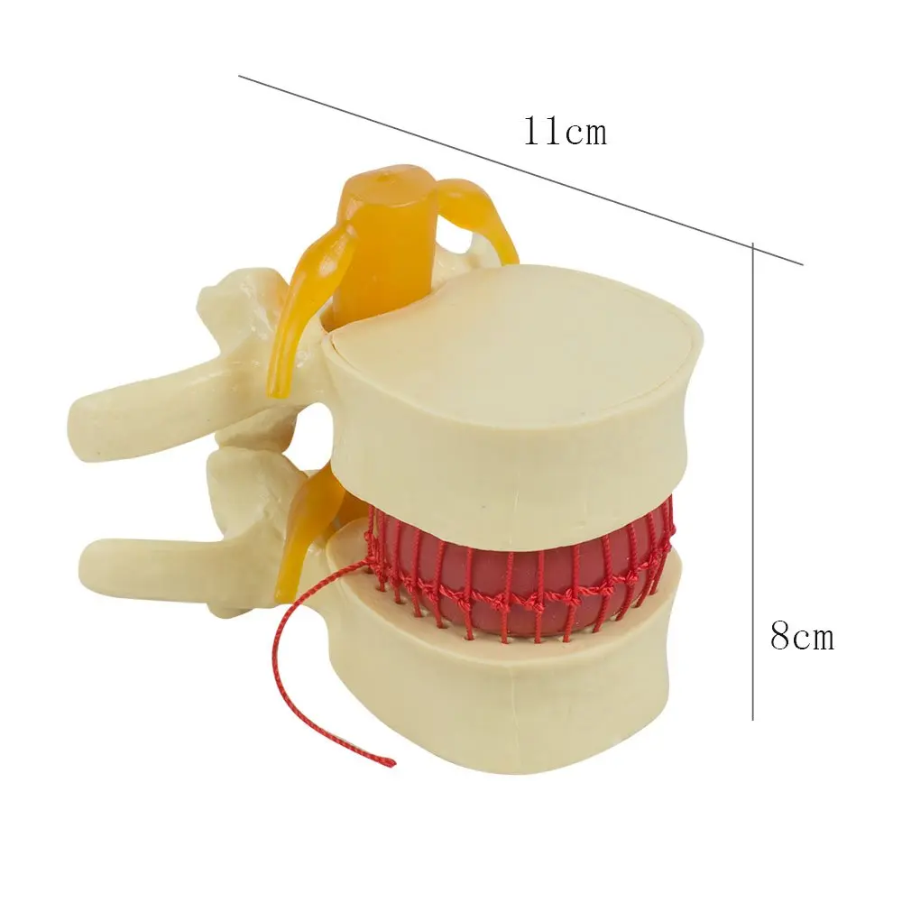 APHRODITE 1.5ครั้งมนุษย์ Lumbar Disc Herniation การสอนของเอวกระดูกสันหลังกระดูกสันหลังกายวิภาครุ่น Soft Enlarge สีเหลือง