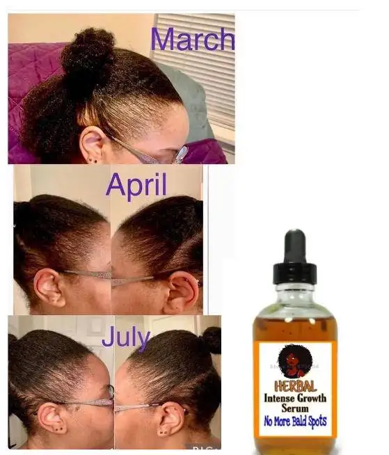 

Edge Growth Oil| Regrow Hair | Hair Loss Oil