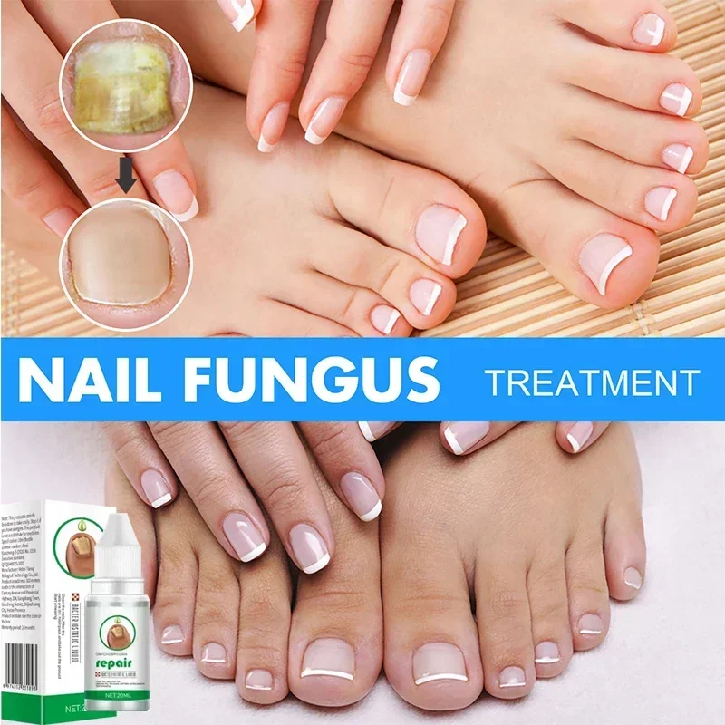 ²⁰²⁵ Effective for 7 days Onychomycosis Nail liquid comes swab to remove onychomycosis