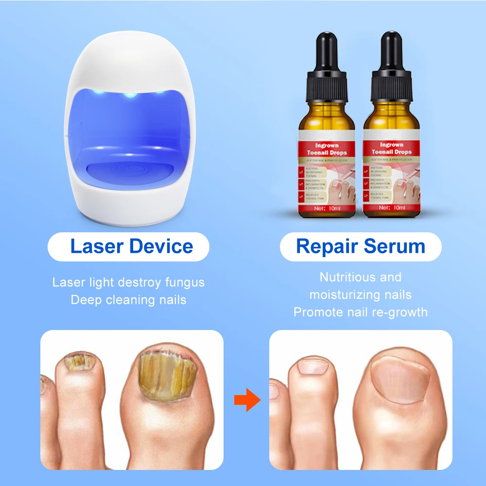 Fungal Nail Device Repair Fast Nails Fungus Onychomycosis