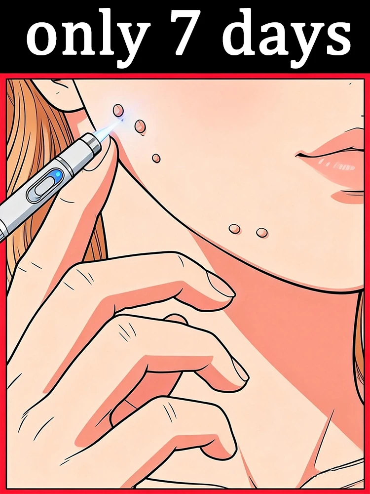 

Синий световой карандаш для удаления бородавок на лице и шее, инструменты для ухода за бородавками