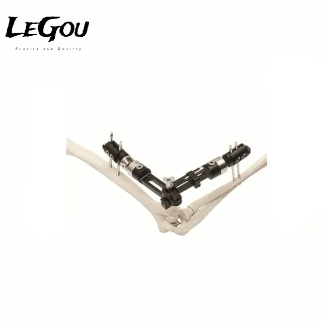 LeGou Professional OF type external fixator lengthening external fixation
