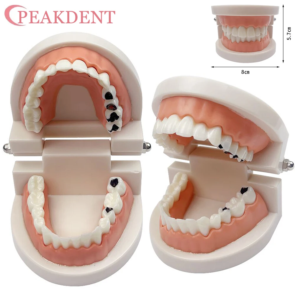 Dental Models Caries Tooth Standard Teeth Model With Dental Education Oral Hygiene Studying Teaching Demonstration Dental types