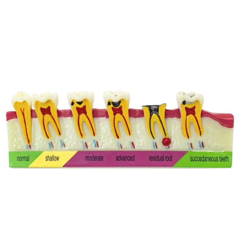 

Dental caries classify Tooth Model of pathological process around teeth caries Evolution decayed Model