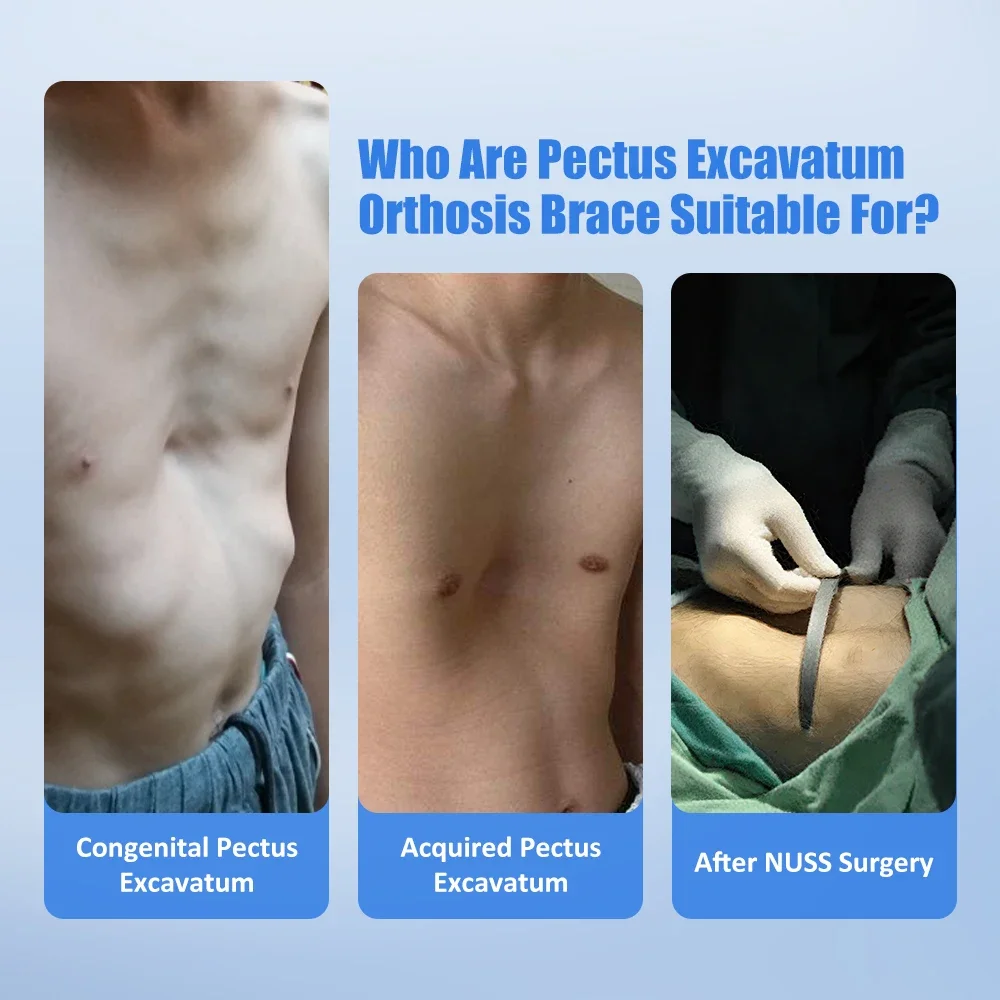 Women Rehabilitation Pectus Excavatum Orthosis Brace Sternal Depression Support Thoracic Sunken Sternum Deformity Tool
