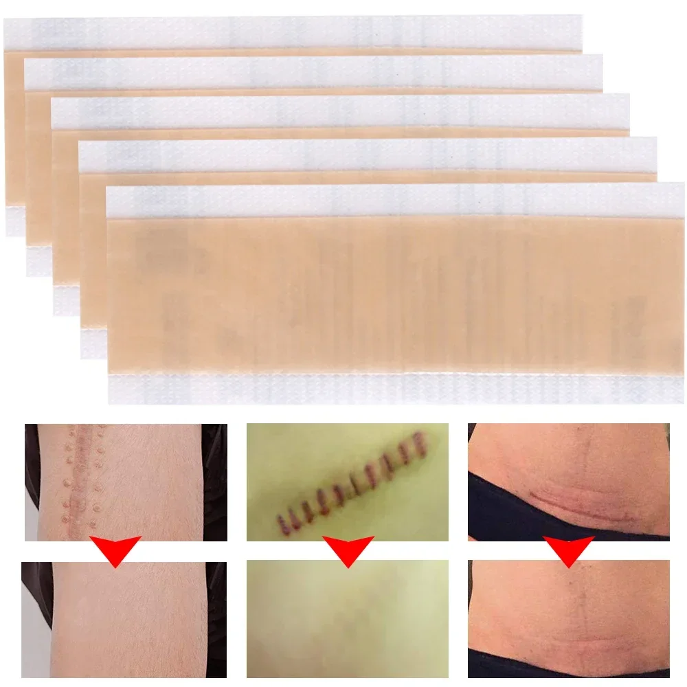 4*15cm Silicone Gel Sheet Efficient Surgery Scar Removal Therapy Patch for Acne Trauma Burn Scar Skin Repair Scar Treatment 1pcs