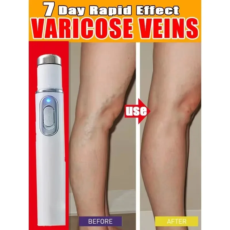 Varicose Vein Lampshade Therapy Effective Improved Blood Circulation Relief Of Dilated Vasculitis In The Legs Phlebitis