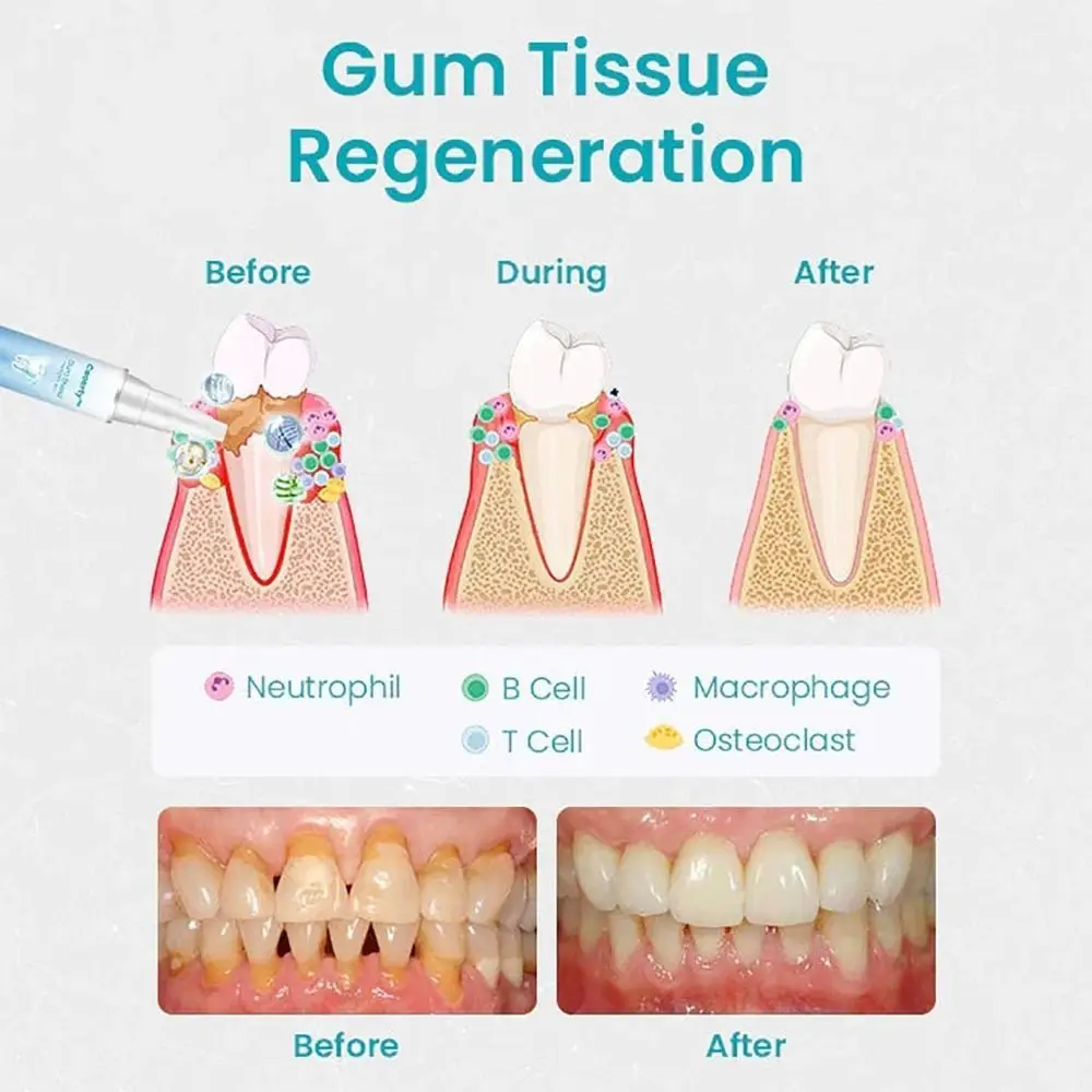 Dental Repair Gum Treatment Gel Reduces Inflammation Reduces Discomfort Gum Shield Therapy Gel Easy to Use Oral Care