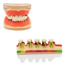 Stomatologiczne patologiczne M4010 M4017 Model zębów choroby przyzębia dorosłych Assort Demo cepillo Dental limpieza stomatologiczne