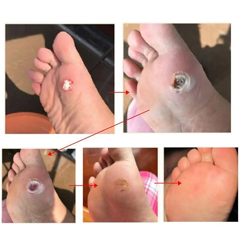 Coussinets adhésifs pour l'élimination des callosités du maïs, autocollants de traitement des pieds, patchs de soin, 6 pièces