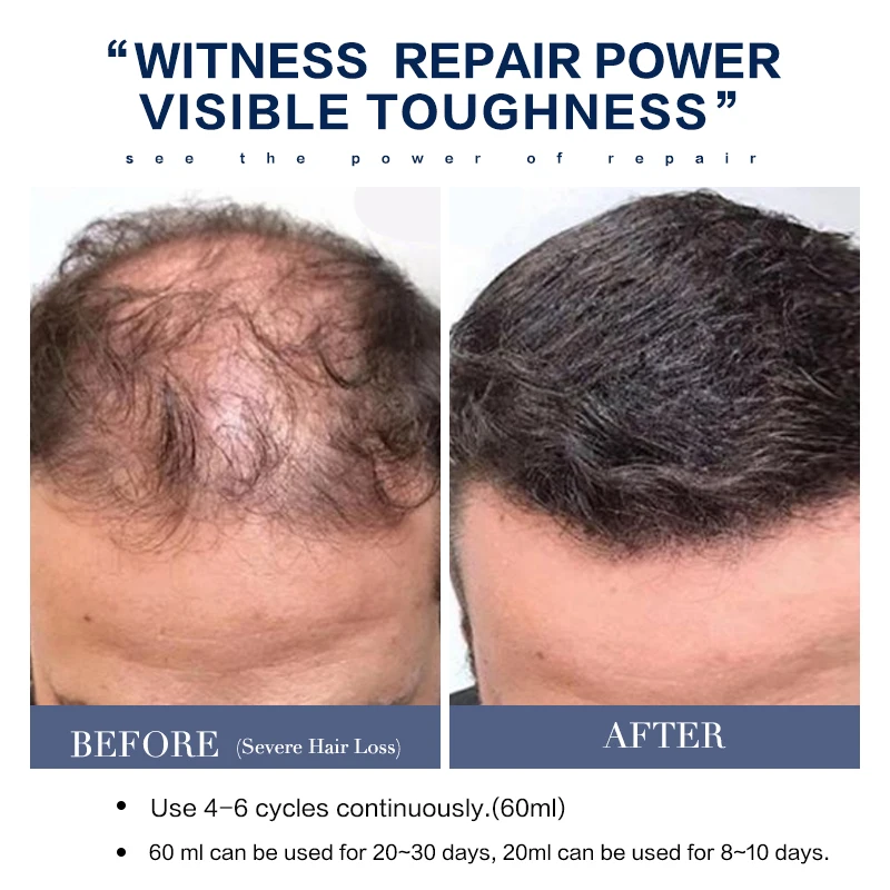Hair Loss Treatment Oil แชมพู Hair Growth Essence แชมพูผม Thickner Hair Serum