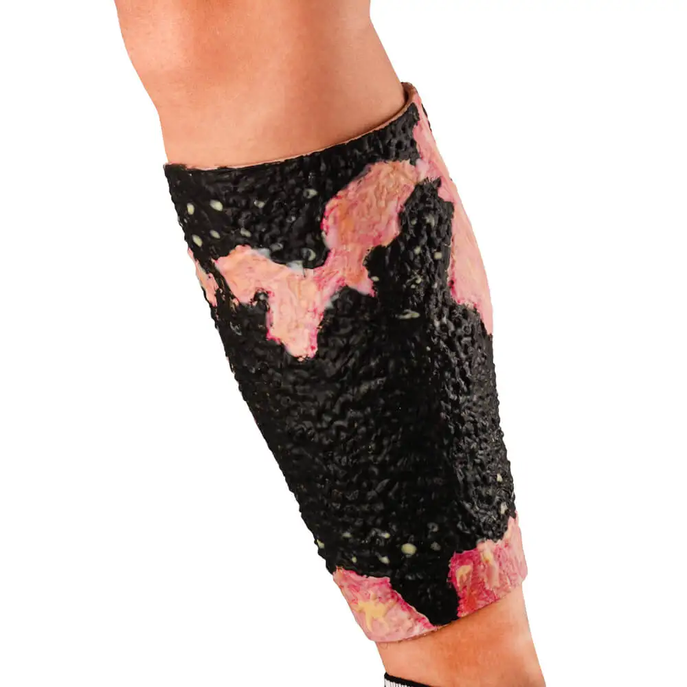 Ultrassist Severe Leg Burn Simulation Sleeve Medical Training Tool for Healthcare Professionals Teaching Education
