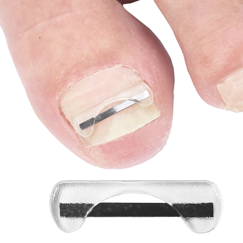 발톱 교정기 티타늄 합금 발톱 교정 와이어 자란 손톱 치료 장치 스티커 실리콘 도구 발 관리