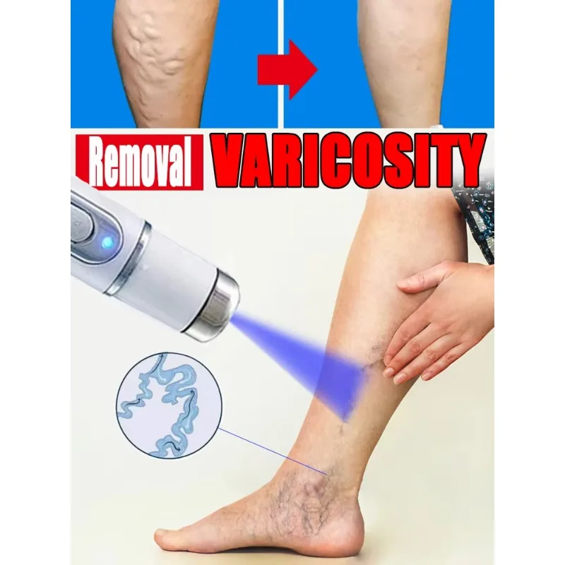 

Varicose Vein Lampshade Therapy Effective Improved Blood Circulation Relief Of Dilated Vasculitis In The Legs Phlebitis 05