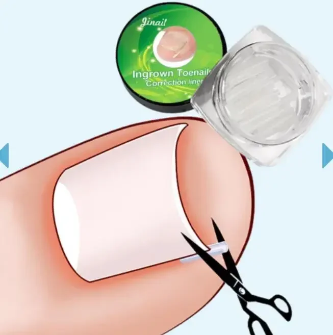 1-100PCS Eingewachsene Zehennagel Korrektur Ultra-dünne Nagel Behandlung Elastische Patch Aufkleber Richt Nägel Nut Eingewachsene Corrector